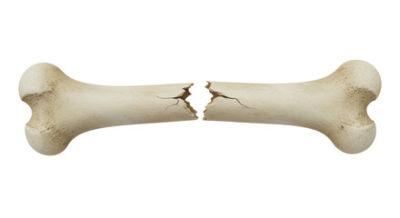 Isolated Broken Bone