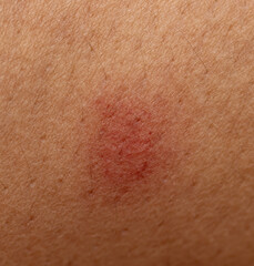 A red mark on a person's arm