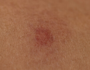 A red mark on a person's arm