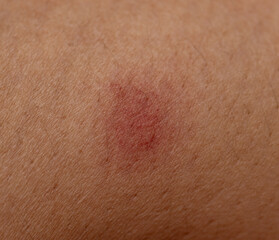Fototapeta premium A red mark on a person's arm