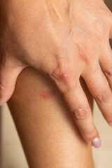 A hand with a red mark on it