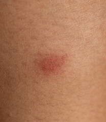A red mark on a person's arm