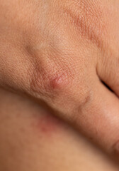 A hand with a red mark on it