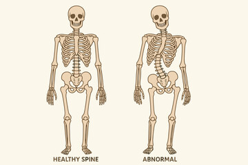 Scoliosis spine curvature medical vector illustration. Comparison of healthy and abnormal human skeleton anatomy. Vertebral column deformity diagram for orthopedics and patient education.