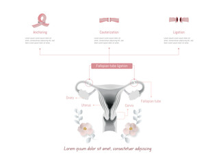 Fallopian tube ligation methods for family planning