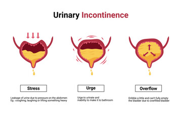 Type of Urinary Incontinence. Overactive bladder illustration. Bladder disease infographic