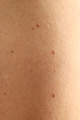 Fototapeta premium Woman with moles on her skin, closeup