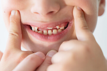 Fototapeta premium Close-up of Baby's First Teeth Coming Through Gums