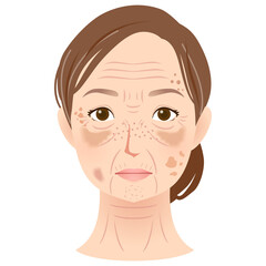 シミができた女性の顔　美容　シニア女性