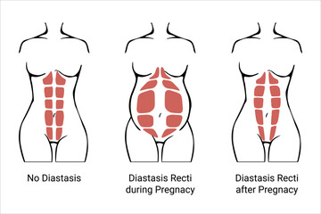 Different types of Diastasis. Diastasis in a woman before, during and after pregnancy. The anatomy of a Woman. A woman's muscular corset before and after childbirth. Vector illustration
