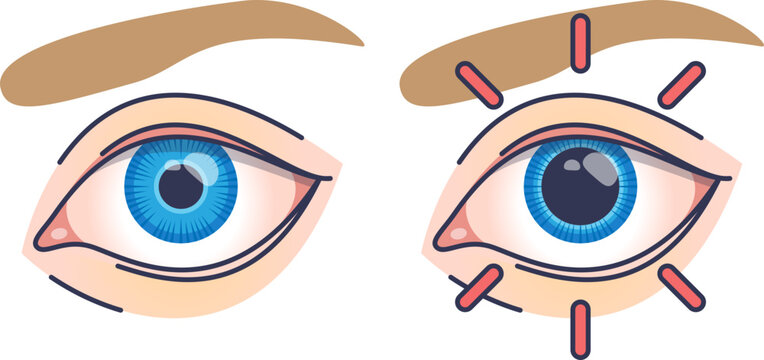 Illustration of eyes with normal and dilated pupils, highlighting pupil dilation.