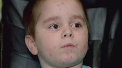 A captivating and expressive portrait of a child with a skin condition chickenpox that conveys...
