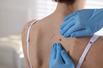 Doctor examining woman's moles in hospital, closeup