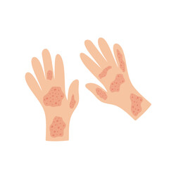 Illustration of a hand affected by allergies. Flat design illustration of a sick hand. Illustration of a hand with red bumps due to allergies