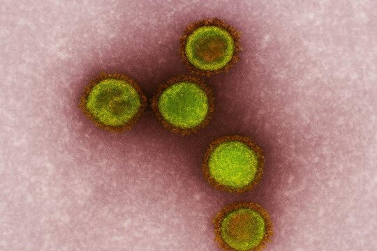 A colorized electron microscope image of Epstein&ndash;Barr virus (EBV) particles, showing spherical green-yellow virions with dark edges on a soft pink and purple cellular background. 