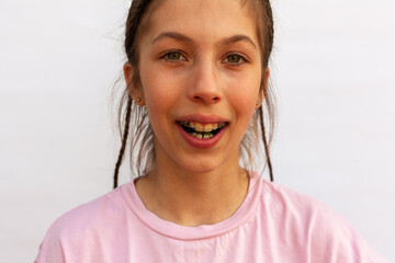 Girl with a wide smile showing the arches of orthodontic plates uneven teeth, malocclusion on a white background