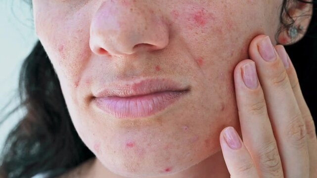 Close-up of the skin of a young girl with problems. Pimples, acne, pores, scars. Natural skin without filters. slow motion
