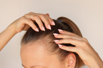 Young woman showing bald spots on forehead and temples with fingers. Baldness. Close-up. Hair care concept and treatment. Hair loss, hair transplant, alopecia