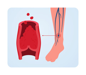 Deep vein thrombosis for healthcare infographic. Vector flat illustration. Vascular disease diagnostic and treatment. Human veins with DVT and blood clot. Design for health care, education