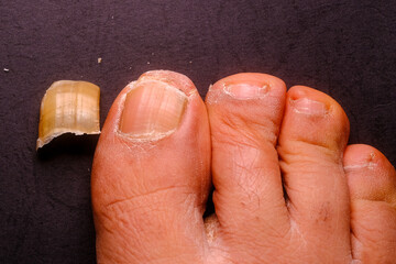 Detached Toenail Next to Damaged Nail Beds