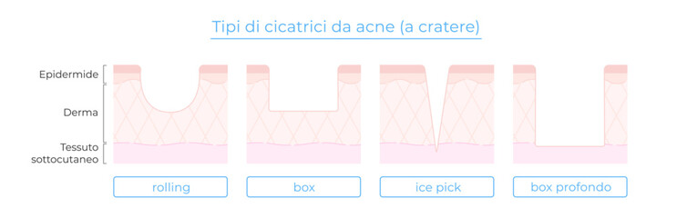 Illustrazione dei tipi di cicatrici da acne: rolling, box, ice pick, box profondo