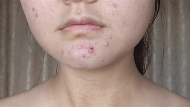 Acne, pimples on the face of a teenage girl. Acne treatment. Dermatological diseases. Eczema.