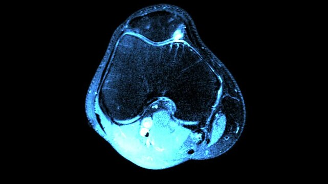 MRI Scan of Right Knee Joint - Ligament Injury and Sports Trauma Diagnosis