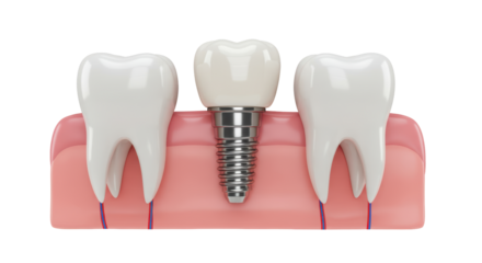 Isolated Tooth Implant