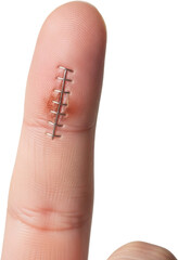 Close-up of a human finger with surgical stitches or sutures on a healing wound, showing medical treatment for a cut or injury with visible skin texture and redness around the area.