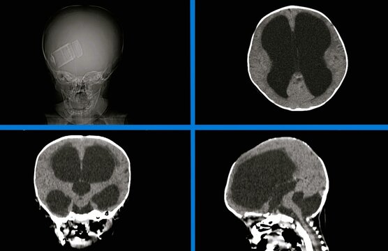 Computed tomography (CT) scan of the brain of a child with hydrocephalus. accumulation of cerebrospinal fluid  leads to dilation of the ventricles 