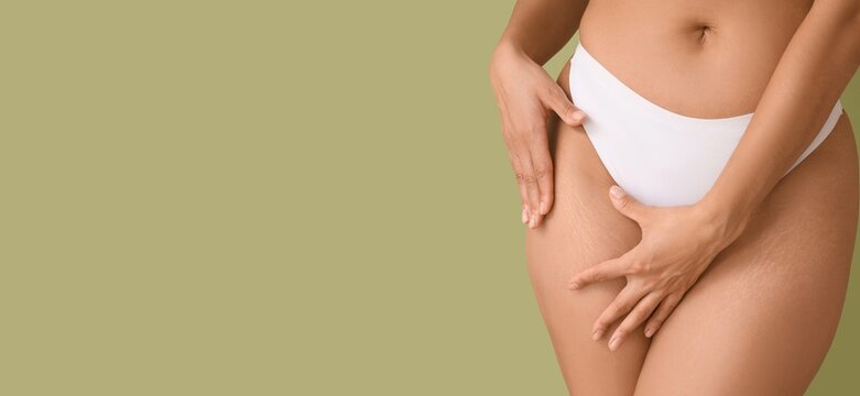 Beautiful young woman with stretch marks on her body against green background with space for text, closeup