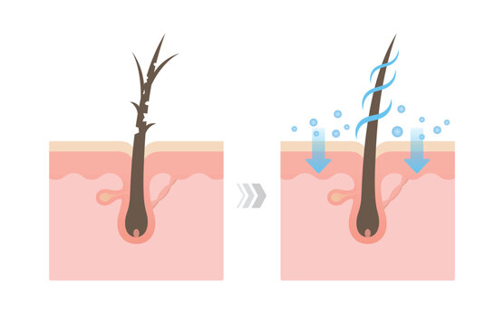 Comparison of damaged and healthy hair shaft on scalp layer vector illustration. Open cuticle versus closed cuticle. Before and after of treatment.
