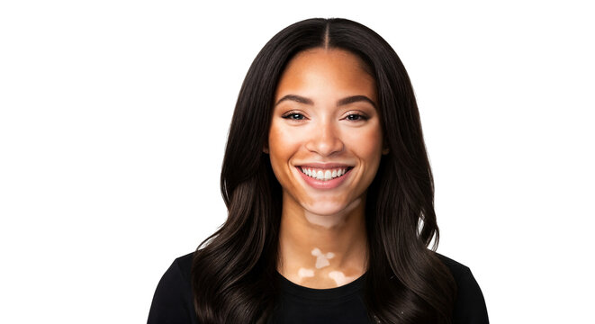 Portrait of Woman with Vitiligo