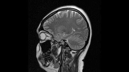 normal T2 sagital plane brain Magnetic resonance imaging (MRI)	