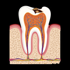 Cracked Tooth Showing Internal Damage