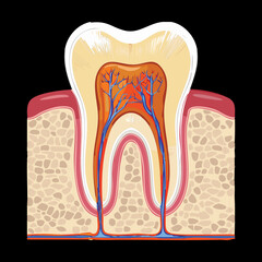 Early Tooth Decay Showing Internal Damage