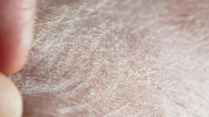 Close-up of a finger touching dry skin closeup. - Powered by Adobe