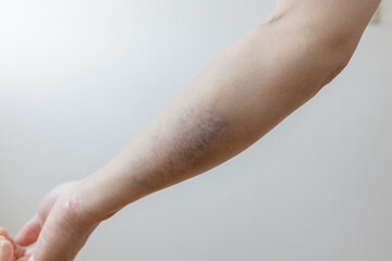 右腕の打撲の青あざ