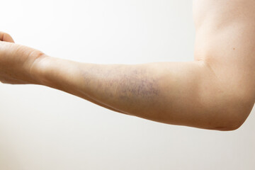 右腕の打撲の青あざ