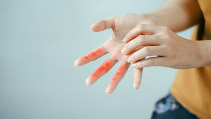 Hand with red inflamed skin on fingers person touching affected area concept of skin irritation allergy eczema or dermatitis close up health care pain discomfort.
