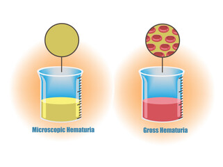 Gross Hematuria and Microscopic Hematuria