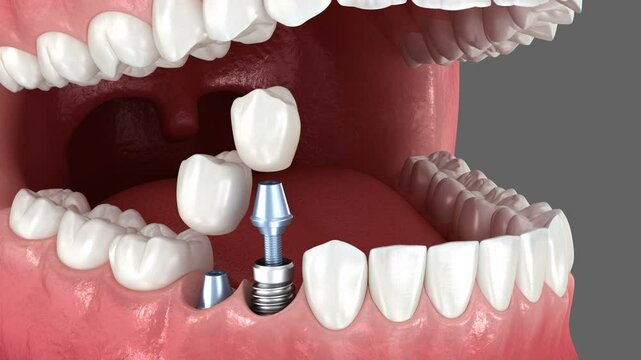 Tooth crowns placement over 3 implants. Dental 3D animation
