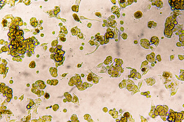Melanoma metastasis cells in the human brain.
