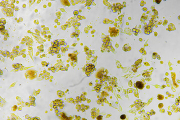 Melanoma metastasis cells in the human brain.