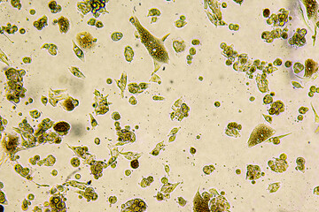 Melanoma metastasis cells in the human brain.