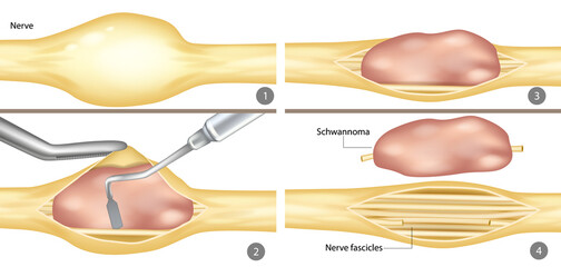 Surgical Removal of Schwannoma from Peripheral Nerve. Step-by-Step Illustration of Schwannoma Excision. Medical Diagram of Nerve Tumor Resection