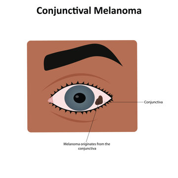 Conjunctival melanoma vector illustration