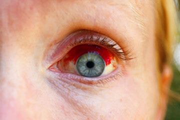 Close up of Women's Eye with Subconjuctival Hemorrhage, Broken Blood Vessel