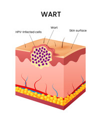 Wart on skin with labeled anatomical features