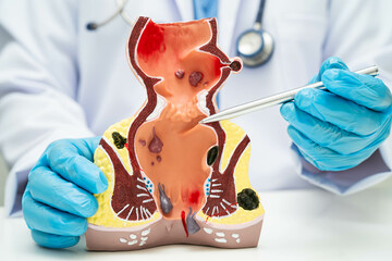 Asian doctor with rectum and hemorrhoid human anatomy model at hospital, inflamed vascular...